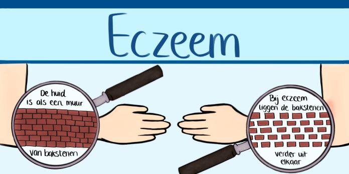 Infographic eczeem