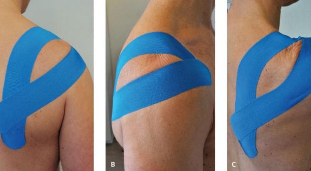 Neuralgische amyotrofie, een (nog) weinig bekende aandoening (AF, BD)