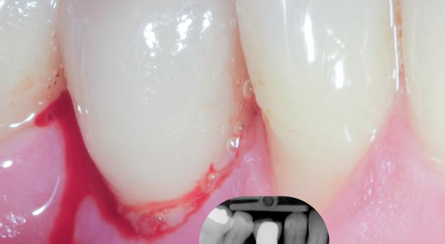 Peri-implantaire ontstekingen: van preventie tot behandeling