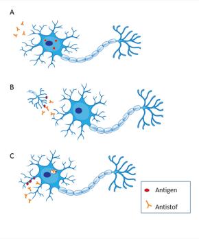 Paraneoplastische neurologische syndromen van het centraal zenuwstelsel 