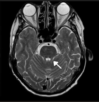 Update genetische ataxieën