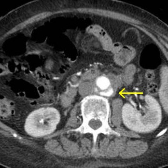 Mycotisch aneurysma van de aorta: een zeldzame complicatie van een geïnfecteerde vaatprothese