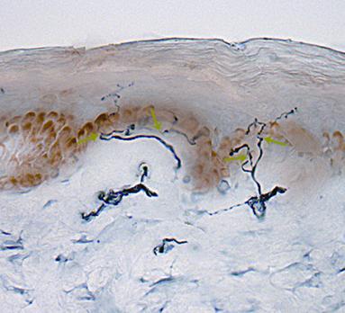 Gemengde gevoelens over gemengde polyneuropathie