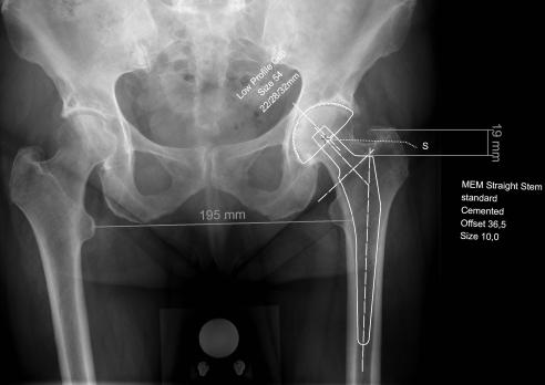 De totale heupprothese