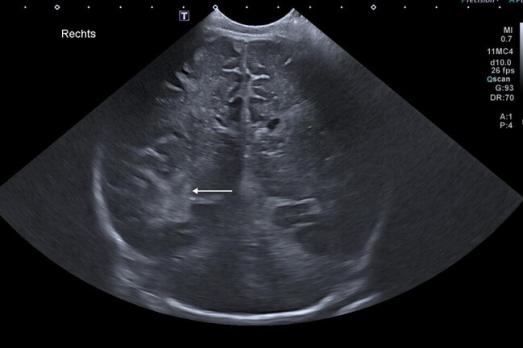 Van smakken tot ademstops: wanneer stuipt een neonaat?