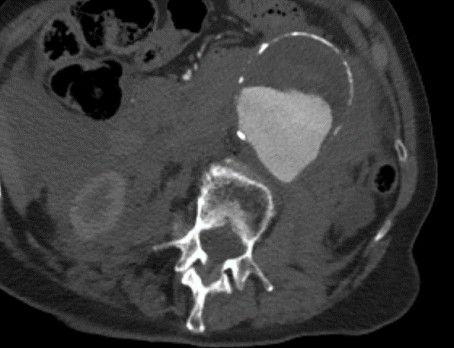 Beeldvormende diagnostiek en radiologische interventies bij het abdominaal aorta-aneurysma 