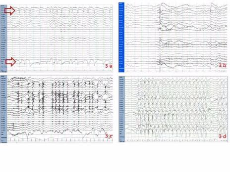 Het eeg in de kindergeneeskundige praktijk