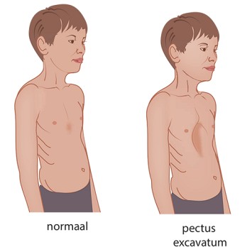 Pectus excavatum: een serieus cardiaal probleem? 