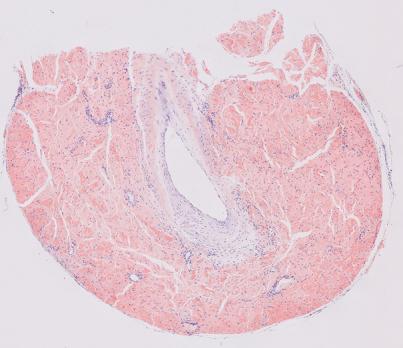 Een bijzondere angiopathie die zich presenteert als grotevatenvasculitis