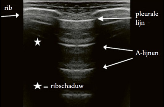 Echografie op de IC 