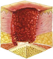 Decubitus bij personen met een dwarslaesie