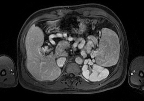 Portale hypertensie – etiologie, diagnostiek en complicaties (deel 1) 