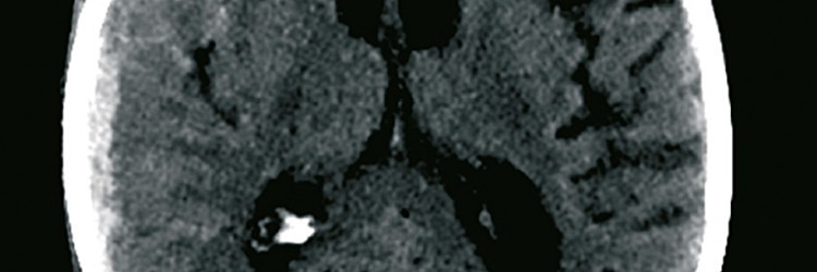 Behandeling van een traumatische intracraniële bloeding onder gebruik van orale anticoagulantia