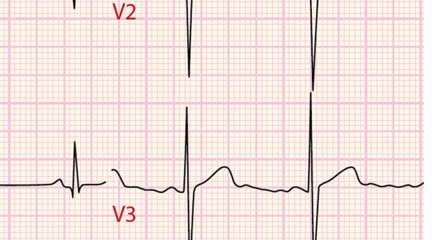  Hoe lees je een ecg? Praktische tips voor niet-kindercardiologen 