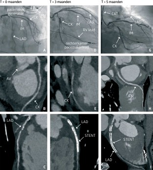 Het is niet altijd atherosclerose – coronaire polyarteriitis nodosa