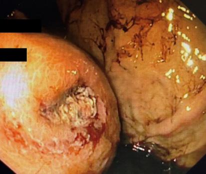 Viscerale aneurysmata: voorkomen, diagnostiek en behandelopties