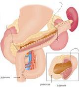 Chronische pancreatitis
