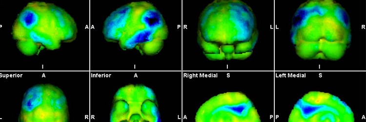 FDG-PET van de hersenen en dementie
