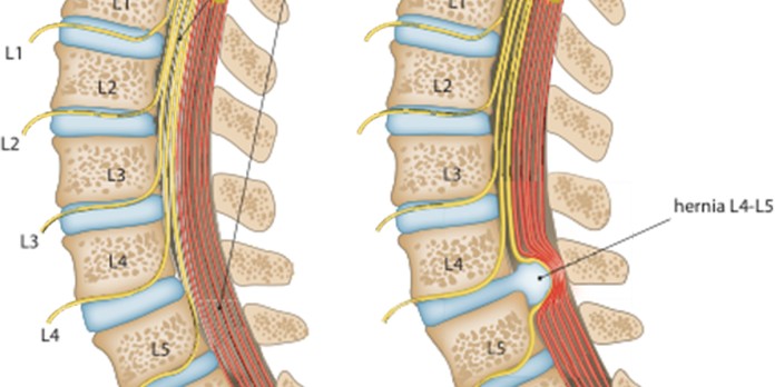 Cauda-equinasyndroom ten gevolge van een HNP: kliniek, diagnostiek, differentiële diagnose en behandeling
