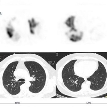 Perfusie-SPECT/CT voor longemboliediagnostiek bij COVID-19geassocieerde ziekte 