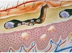 Scabiës, terug van weggeweest