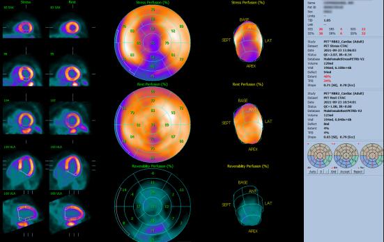 Diagnostiek en behandeling van stabiel coronairlijden: Rubidium-82-myocardperfusie-PET/CT