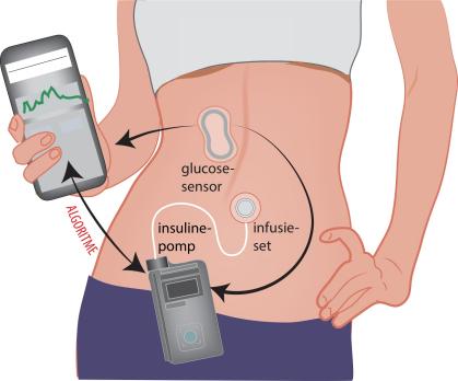 Technologie in de behandeling van diabetes