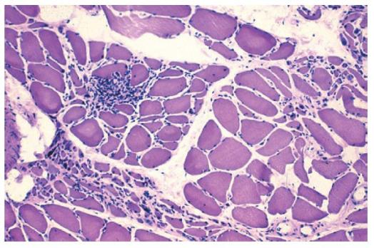 Polymyositis