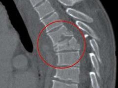 Specifieke aandoeningen aan de wervelkolom