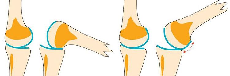  Een bindweefselfysiologische kijk op artrose