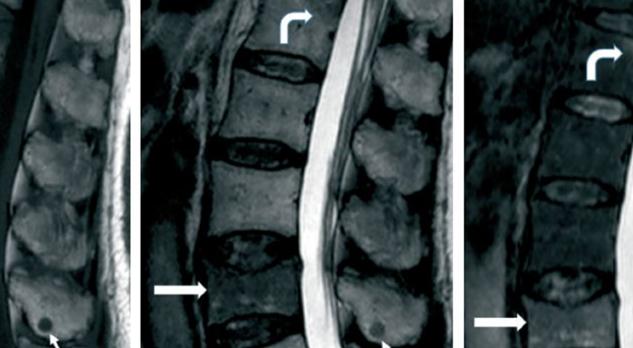 Beeldvorming bij spondylodiscitis