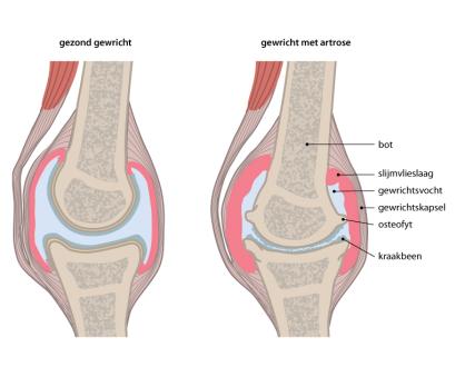 Artrose, een veelvoorkomende aandoening