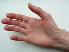 Diagnostiek en therapie bij pijn in de duimregio