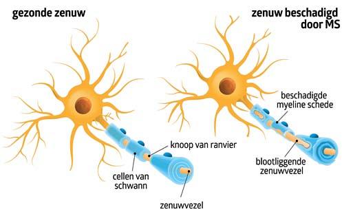 Farmacotherapie van multipele sclerose