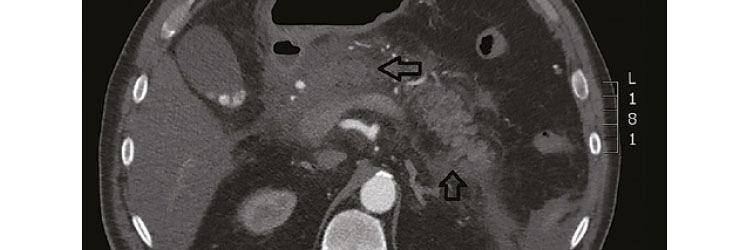 Acute pancreatitis