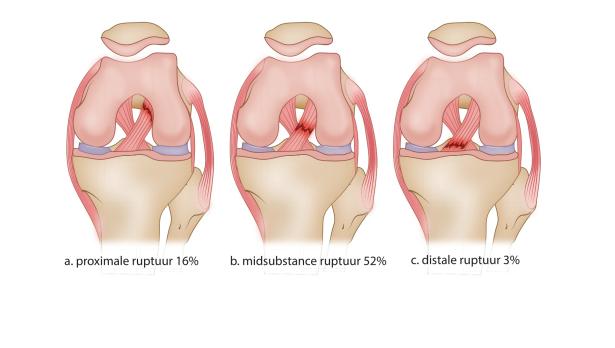 Anatomie, trauma en herstel van de voorste-kruisband (SF, VI)