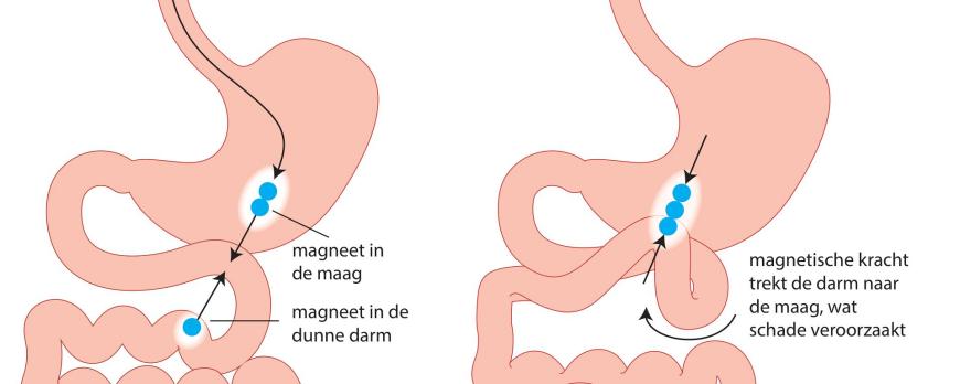 Van spelen naar kleven: een praktische aanpak bij multipele magneetingesties