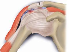 Pathologie en diagnostiek van subacromiale klachten