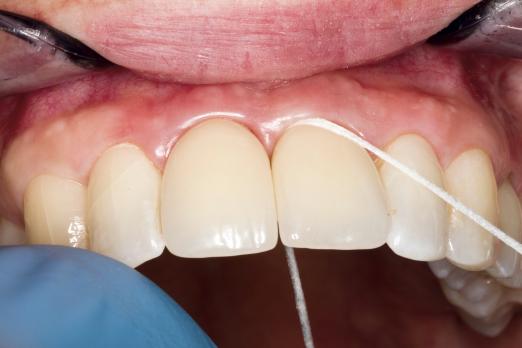 Nazorg bij implantaten