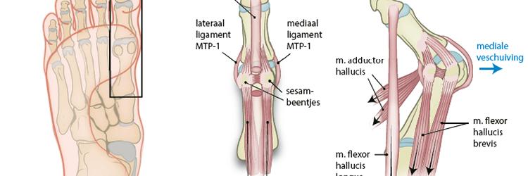 Ingrediënten voor een oefenprotocol bij een hallux valgus