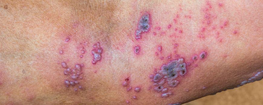 Van pijnprofiel tot pijnbehandeling