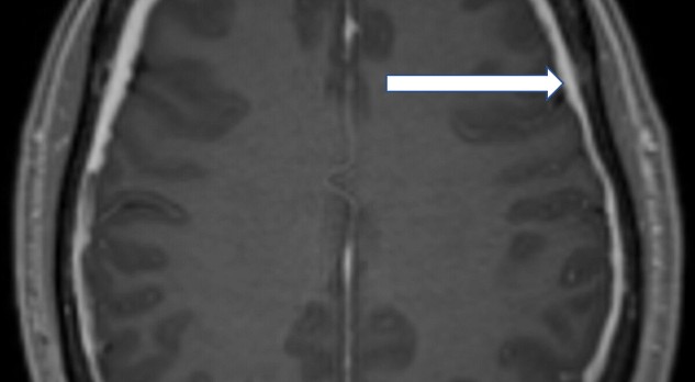 Spontane intracraniële hypotensie