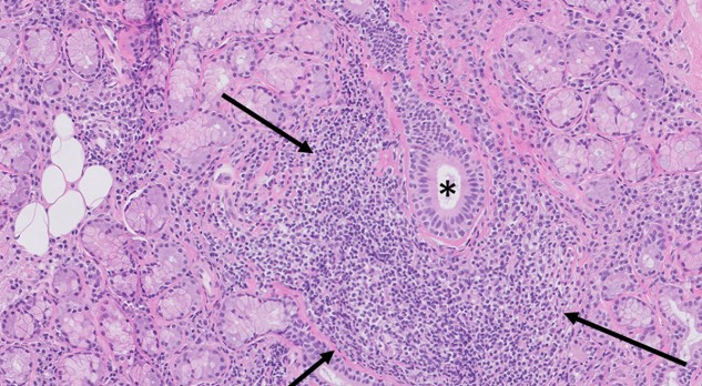 Neurologische manifestaties bij het syndroom van Sjögren