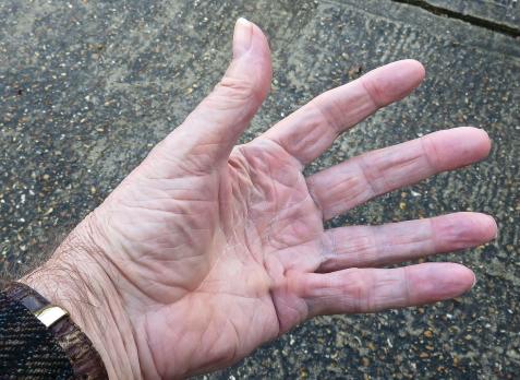 Adaptatie en mobilisatie van bindweefsel (VI)