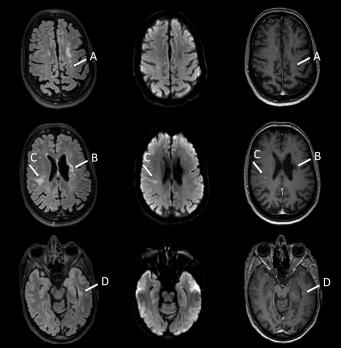 Cerebrale hereditaire angiopathieën (CHA) 