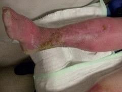 Een patiënt met een rood been; toepassing van de nieuwe richtlijn cellulitis/erysipelas