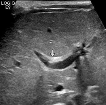 Vroegdetectie en diagnose van galgangatresie