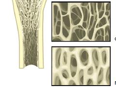 Osteoporose