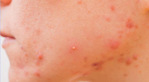 Acne vulgaris