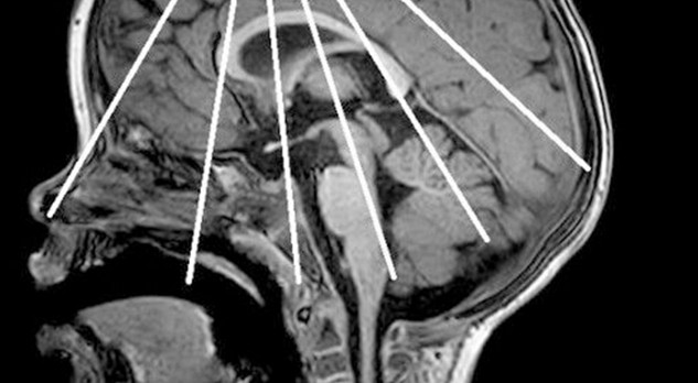 Echografie van de schedel bij de neonaat 